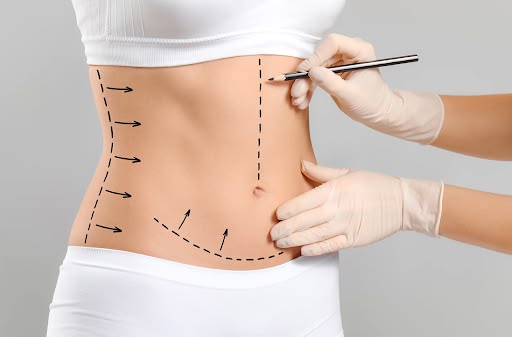 Compression Garments and Massage: The Unsung Heroes of Liposuction Recovery